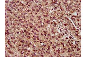 IHC image of ABIN7159657 diluted at 1:300 and staining in paraffin-embedded human glioma performed on a Leica BondTM system. (MMADHC anticorps  (AA 26-142))