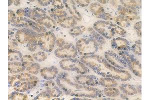 ABIN6261450 and ABIN6266845 at 1/100 staining human renal cell carcinoma by IHC-P. (EFNA4 anticorps  (Internal Region))