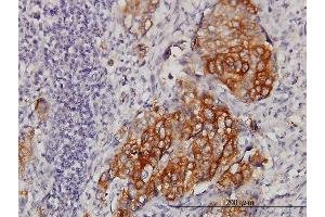 Immunoperoxidase of monoclonal antibody to EIF4G3 on formalin-fixed paraffin-embedded human lung, adenosquamous cell carcinoma. (EIF4G3 anticorps  (AA 1-515))