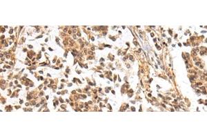 Immunohistochemistry of paraffin-embedded Human breast cancer tissue using NHLRC2 Polyclonal Antibody at dilution of 1:40(x200) (NHLRC2 anticorps)