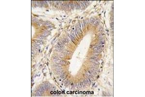 Formalin-fixed and paraffin-embedded human colon carcinoma tissue reacted with AKR1B1 antibody (Center) (ABIN389206 and ABIN2839364) , which was peroxidase-conjugated to the secondary antibody, followed by DAB staining.