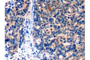 Detection of PD1 in Human Ovarian cancer Tissue using Polyclonal Antibody to Programmed Cell Death Protein 1 (PD1) (PD-1 anticorps  (AA 41-132))