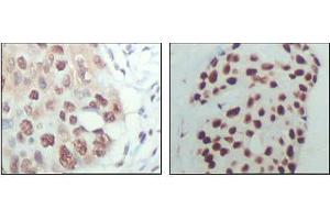 Immunohistochemical analysis of paraffin-embedded human esophagus cancer (left) and breast carcinoma tissue (right), showing nuclear localization with DAB staining using HDAC3 antibody. (HDAC3 anticorps  (AA 224-428))
