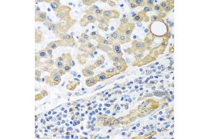 Immunohistochemistry of paraffin-embedded human liver cancer using GLUD1 antibody.