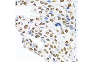 Immunohistochemistry of paraffin-embedded human prostate cancer using PTBP1 antibody.