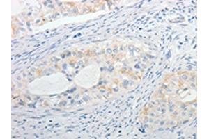 The image on the left is immunohistochemistry of paraffin-embedded Human cervical cancer tissue using ABIN7130256(MPZ Antibody) at dilution 1/15, on the right is treated with fusion protein.