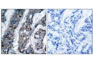 Immunohistochemical analysis of paraffin-embedded human breast carcinoma tissue using HER2 (phospho-Tyr1248) antibody (E011079). (ErbB2/Her2 anticorps  (pTyr1248))