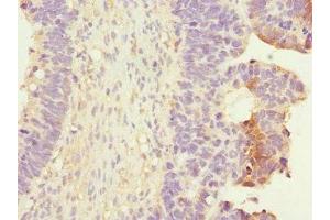 Immunohistochemistry of paraffin-embedded human ovarian cancer using ABIN7167394 at dilution of 1:100 (RALB anticorps  (AA 1-206))