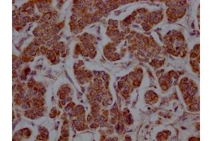 IHC image of ABIN7127629 diluted at 1:100 and staining in paraffin-embedded human breast cancer performed on a Leica BondTM system.