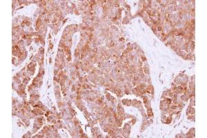 IHC-P Image Immunohistochemical analysis of paraffin-embedded human adenocarcinoma, using HPRT, antibody at 1:500 dilution. (HPRT1 anticorps)