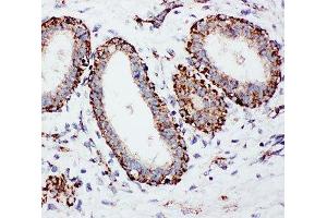 IHC-P: MTCO1 antibody testing of human breast cancer tissue (COX1 anticorps  (C-Term))