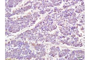 Formalin-fixed and paraffin embedded human lung carcinoma labeled with Anti phospho-STAT1 (Ser727) Polyclonal Antibody, Unconjugated (ABIN746168) at 1:200 followed by conjugation to the secondary antibody and DAB staining (STAT1 anticorps  (pSer727))