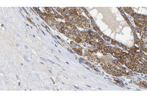ABIN6269219 at 1/100 staining Human liver cancer tissue by IHC-P. (Cadherin 5 anticorps  (C-Term))