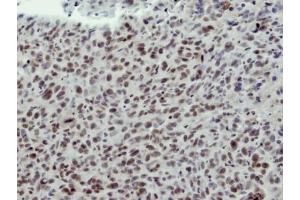 IHC-P Image Immunohistochemical analysis of paraffin-embedded HS578T xenograft, using CLP1, antibody at 1:100 dilution. (CLP1 anticorps  (Center))