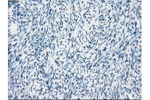 Immunohistochemical staining of paraffin-embedded Adenocarcinoma of breast tissue using anti-FOSL1 mouse monoclonal antibody. (FOSL1 anticorps)