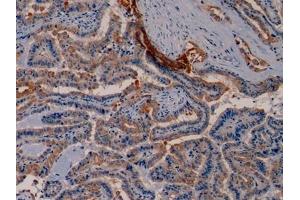 Detection of CK19 in Human Thyroid cancer Tissue using Monoclonal Antibody to Cytokeratin 19 (CK19) (Cytokeratin 19 anticorps  (AA 245-391))