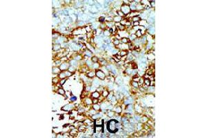 Formalin-fixed and paraffin-embedded human hepatocellular carcinoma tissue reacted with MAP4K2 polyclonal antibody  , which was peroxidase-conjugated to the secondary antibody, followed by AEC staining . (MAP4K2 anticorps  (Internal Region))