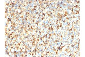 Formalin-fixed, paraffin-embedded human Melanoma stained with CD63-Monospecific Recombinant Mouse Monoclonal Antibody (rMX-49.