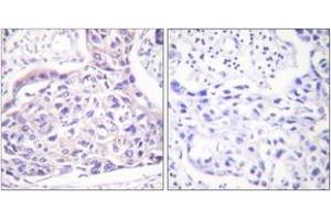 Immunohistochemistry analysis of paraffin-embedded human breast carcinoma, using IRS-1 (Phospho-Ser323) Antibody. (IRS1 anticorps  (pSer323))