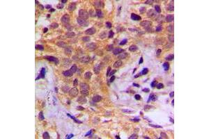 Immunohistochemical analysis of HSP90 beta (pS254) staining in human breast cancer formalin fixed paraffin embedded tissue section. (HSP90AB1 anticorps  (pSer254))