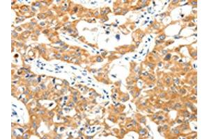 The image on the left is immunohistochemistry of paraffin-embedded Human lung cancer tissue using ABIN7192878(TRAF3 Antibody) at dilution 1/40, on the right is treated with synthetic peptide. (TRAF3 anticorps)