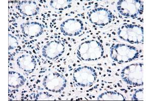 Immunohistochemical staining of paraffin-embedded Adenocarcinoma of ovary tissue using anti-CHEK2mouse monoclonal antibody. (CHEK2 anticorps)