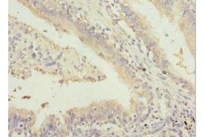 Immunohistochemistry of paraffin-embedded human lung cancer using ABIN7153505 at dilution of 1:100 (GABRR1 anticorps  (AA 365-465))