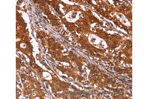Immunohistochemistry of Human gastric cancer using ABI1 Polyclonal Antibody at dilution of 1:40 (ABI1 anticorps)