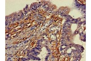 Immunohistochemistry of paraffin-embedded human colon cancer using ABIN7166338 at dilution of 1:100 (YIPF3 anticorps  (AA 2-148))
