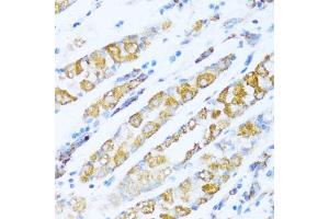 Immunohistochemistry of paraffin-embedded human gastric cancer using NDUF antibody (ABIN7268804) at dilution of 1:100 (40x lens).