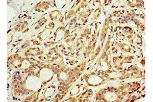 Immunohistochemistry of paraffin-embedded human breast cancer using ABIN7143228 at dilution of 1:100 (ACSM3 anticorps  (AA 387-586))