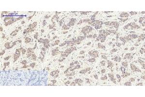 Immunohistochemistry of paraffin-embedded Human liver cancer tissue using EIF2 alpha Polyclonal Antibody at dilution of 1:200.