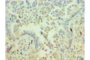 Immunohistochemistry of paraffin-embedded human lung cancer using ABIN7156537 at dilution of 1:100 (ICAM2 anticorps  (AA 25-223))