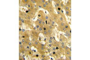 Formalin-fixed and paraffin-embedded human hepatocarcinoma reacted with SCP2 Antibody , which was peroxidase-conjugated to the secondary antibody, followed by DAB staining.