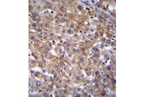 Immunohistochemistry analysis in formalin fixed and paraffin embedded human liver tissue reacted with PLEKHA4 Antibody (N-term) followed which was peroxidase conjugated to the secondary antibody and followed by DAB staining.