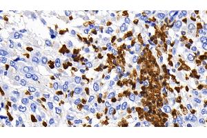Detection of CASP1 in Human Liver cancer Tissue using Polyclonal Antibody to Caspase 1 (CASP1)