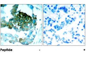 Immunohistochemical analysis of paraffin-embedded human lung carcinoma tissue using PRKCQ polyclonal antibody . (PKC theta anticorps)