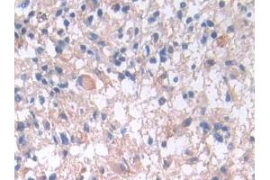 Detection of IL33 in Human Glioma Tissue using Monoclonal Antibody to Interleukin 33 (IL33)