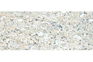 Immunohistochemistry of paraffin-embedded Human esophagus cancer tissue using DENND6A Polyclonal Antibody at dilution of 1:120(x200) (FAM116A anticorps)