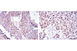 Immunohistochemical analysis of paraffin-embedded lung cancer tissues (left) and kidney cancer tissues (right) using HSP60 mouse mAb with DAB staining.