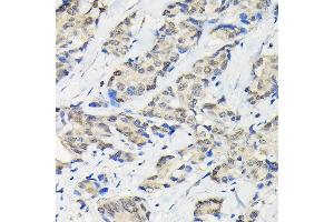 Immunohistochemistry of paraffin-embedded human breast cancer using SSN Rabbit pAb (3377) at dilution of 1:100 (40x lens).