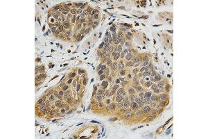 Immunohistochemistry of paraffin-embedded human esophageal cancer using ABO antibody at dilution of 1:200 (x400 lens). (ABO anticorps)