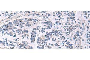 Immunohistochemistry of paraffin-embedded Human breast cancer tissue using LAMP3 Polyclonal Antibody at dilution of 1:30(x200) (LAMP3 anticorps)