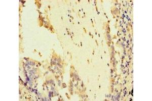 Immunohistochemistry of paraffin-embedded human lung cancer using ABIN7169011 at dilution of 1:100 (ATR anticorps  (AA 2405-2644))