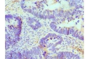 Immunohistochemistry of paraffin-embedded human ovarian cancer using ABIN7145049 at dilution of 1:100