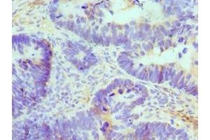 Immunohistochemistry of paraffin-embedded human ovarian cancer using ABIN7145049 at dilution of 1:100 (ATRIP anticorps  (AA 1-260))
