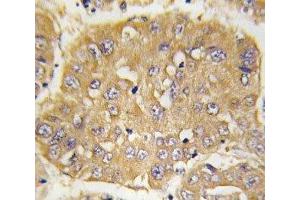 IHC analysis of FFPE human hepatocarcinoma tissue stained with IGFBP3 antibody