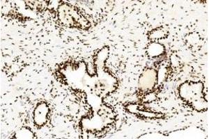 Immunohistochemical analysis of paraffin-embedded Human Prostate cancer section using Pink1 B.