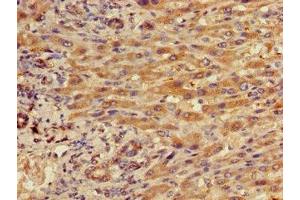 Immunohistochemistry of paraffin-embedded human liver cancer using ABIN7156490 at dilution of 1:100 (Integrin beta 5 anticorps  (AA 431-637))