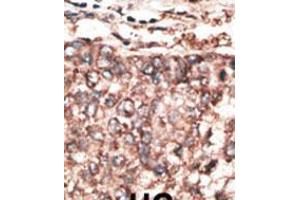 Formalin-fixed and paraffin-embedded human cancer tissue reacted with the primary antibody, which was peroxidase-conjugated to the secondary antibody, followed by AEC staining. (PDGFD anticorps  (AA 313-341))